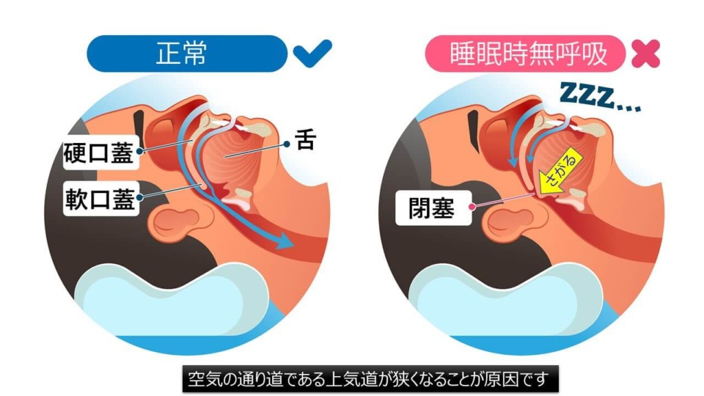 睡眠時無呼吸症候群